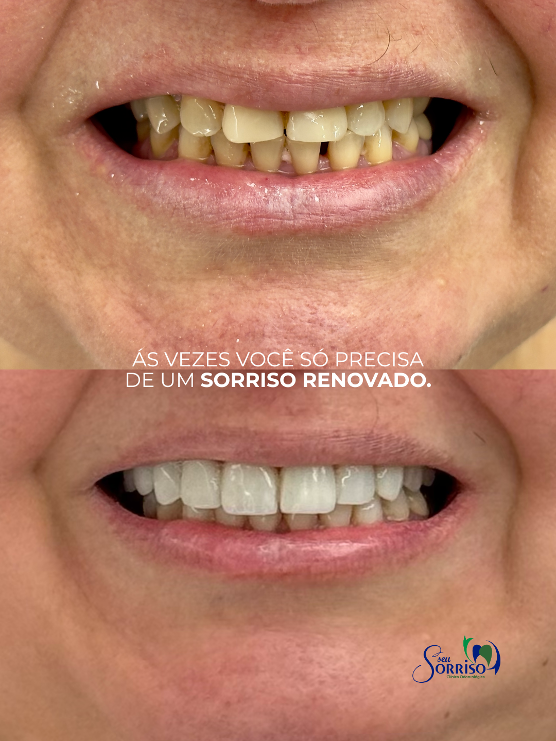 Caso real de transformação de sorriso, antes e depois