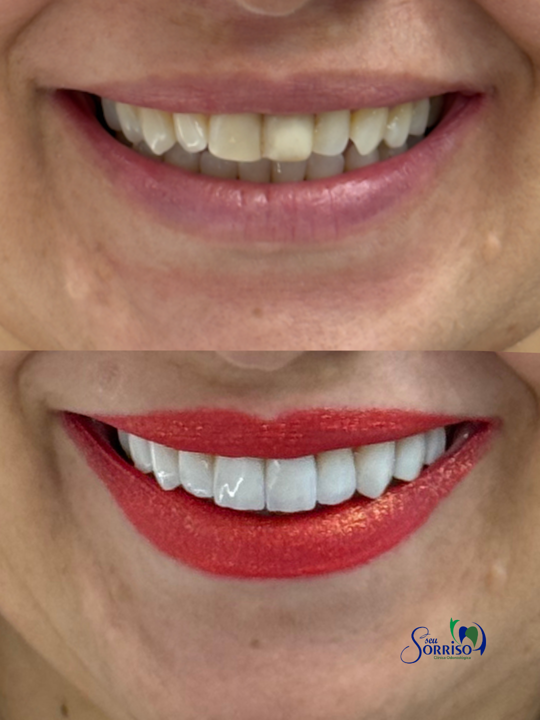 Caso real de facetas dentárias, antes e depois