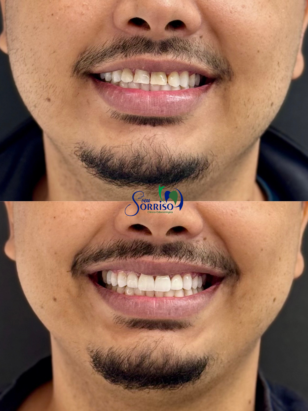 Caso real de facetas dentárias, antes e depois