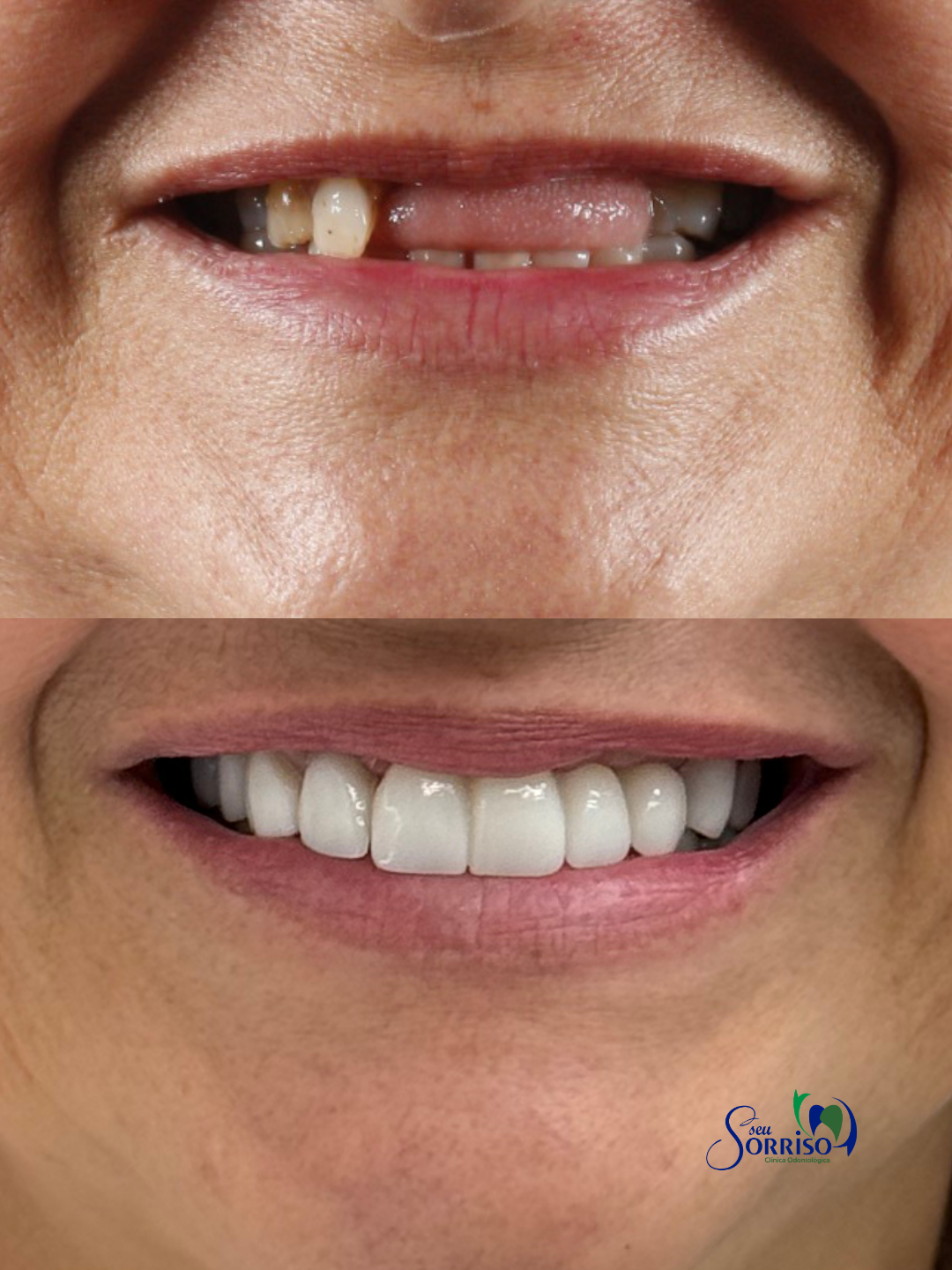 Caso real de reabilitação com implantes dentários, antes e depois