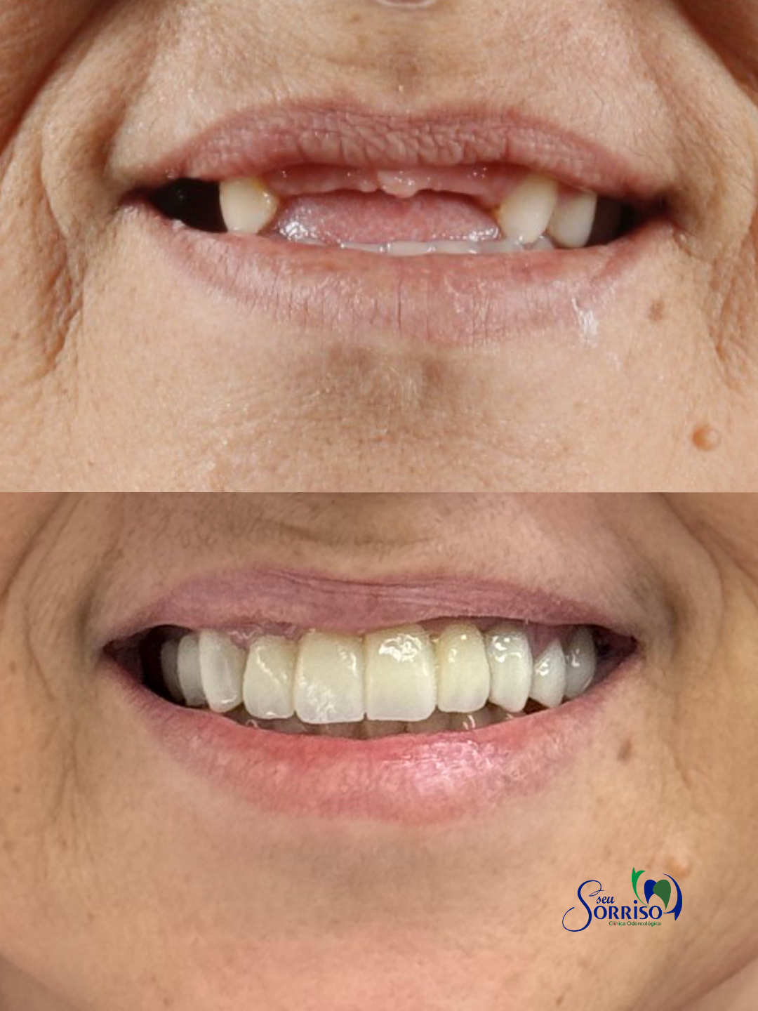 Caso real de reabilitação completa do sorriso com implantes dentários, antes e depois