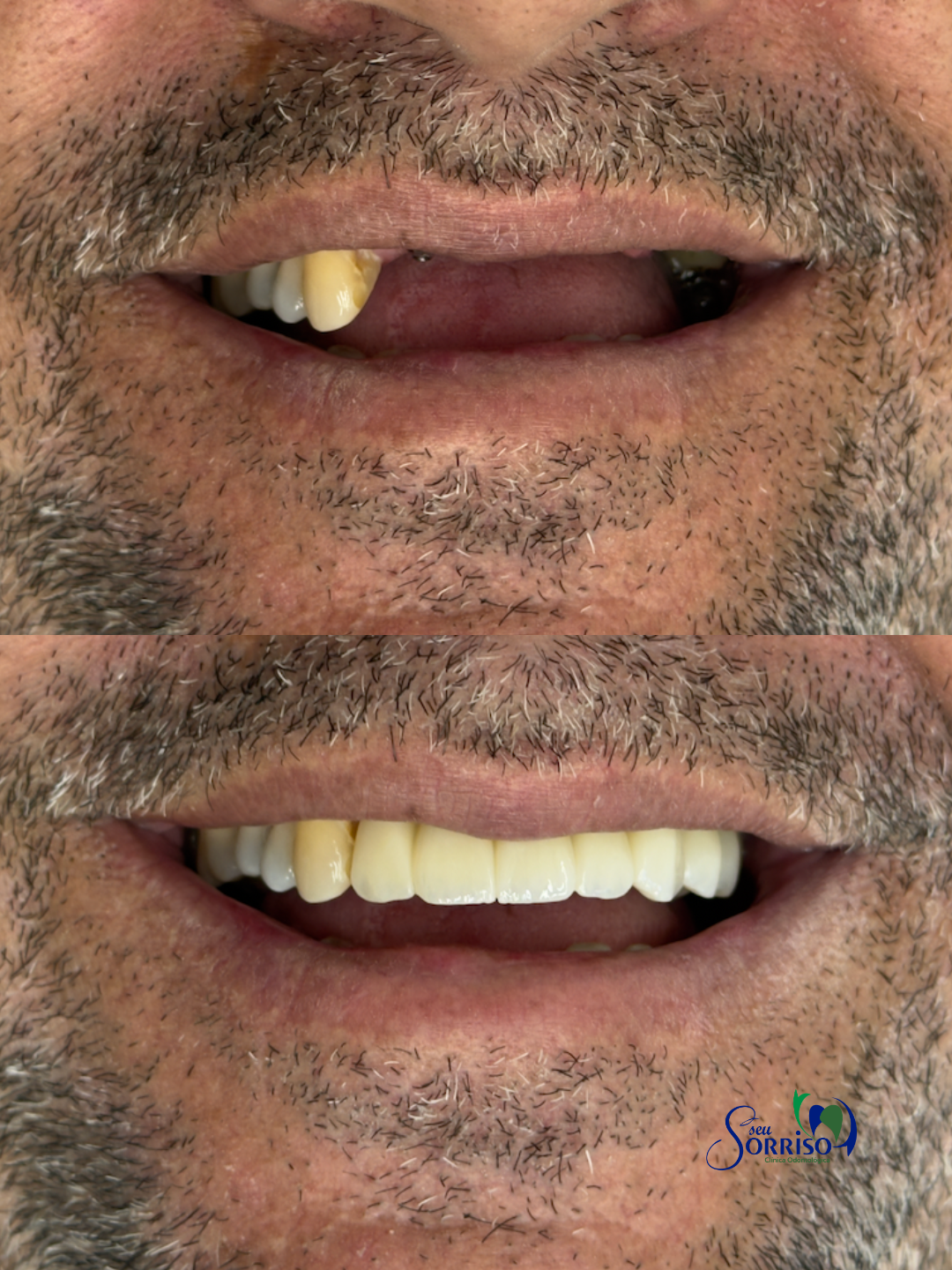 Caso real de protocolo sobre implante dentário, antes e depois